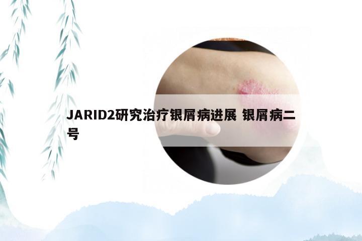JARID2研究治疗银屑病进展 银屑病二号