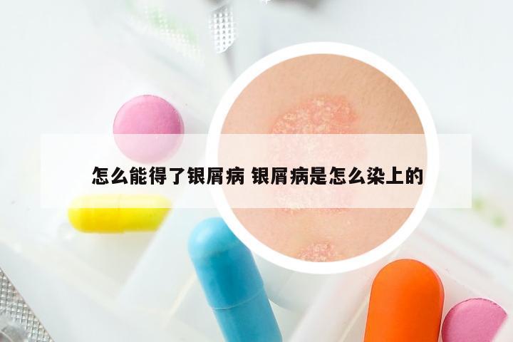 怎么能得了银屑病 银屑病是怎么染上的