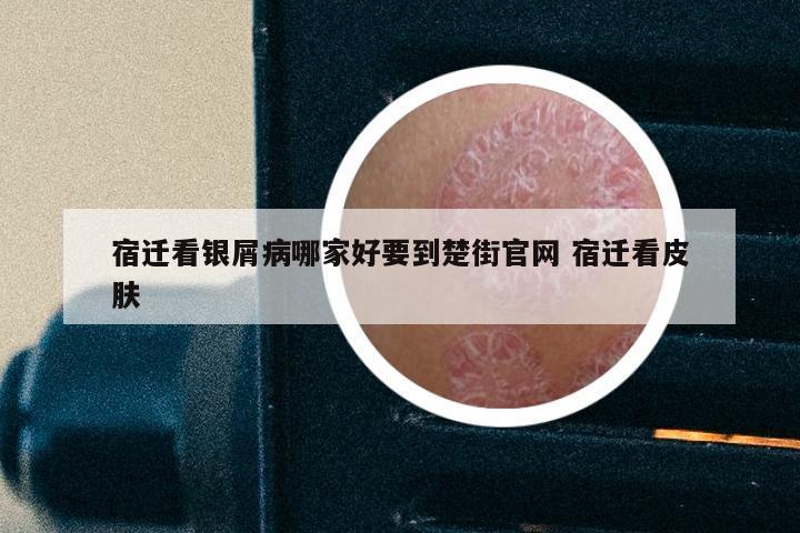 宿迁看银屑病哪家好要到楚街官网 宿迁看皮肤