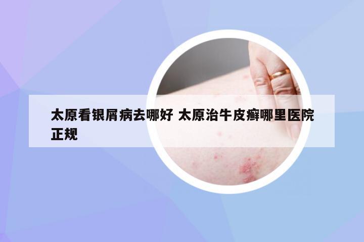 太原看银屑病去哪好 太原治牛皮癣哪里医院正规