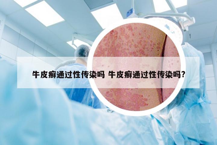 牛皮癣通过性传染吗 牛皮癣通过性传染吗?