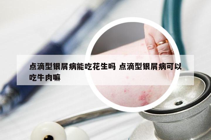点滴型银屑病能吃花生吗 点滴型银屑病可以吃牛肉嘛