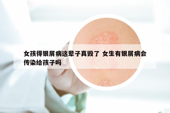 女孩得银屑病这辈子真毁了 女生有银屑病会传染给孩子吗
