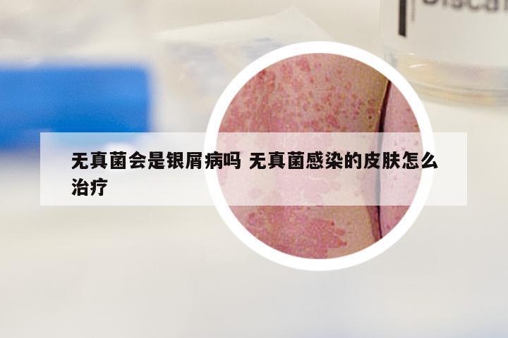 无真菌会是银屑病吗 无真菌感染的皮肤怎么治疗