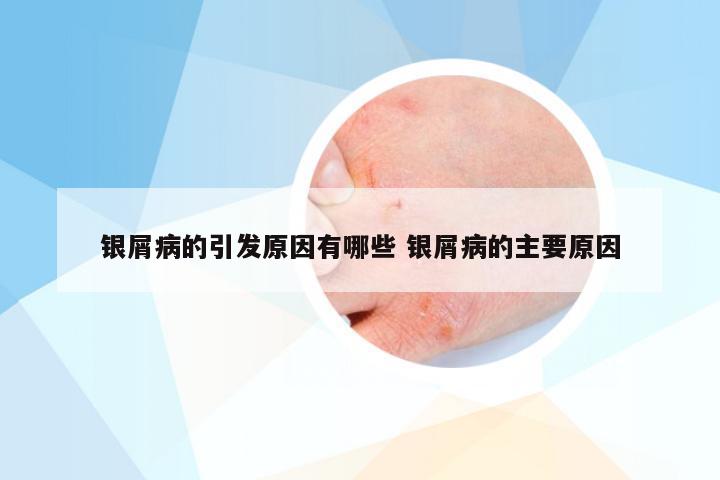 银屑病的引发原因有哪些 银屑病的主要原因