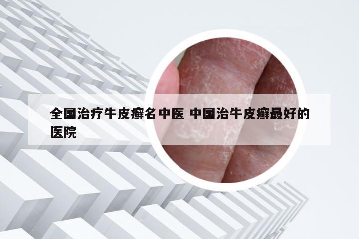 全国治疗牛皮癣名中医 中国治牛皮癣最好的医院