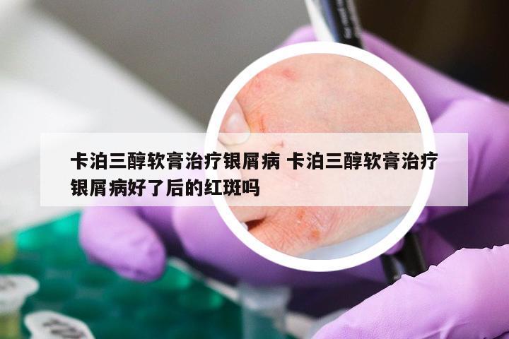 卡泊三醇软膏治疗银屑病 卡泊三醇软膏治疗银屑病好了后的红斑吗