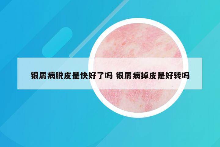 银屑病脱皮是快好了吗 银屑病掉皮是好转吗