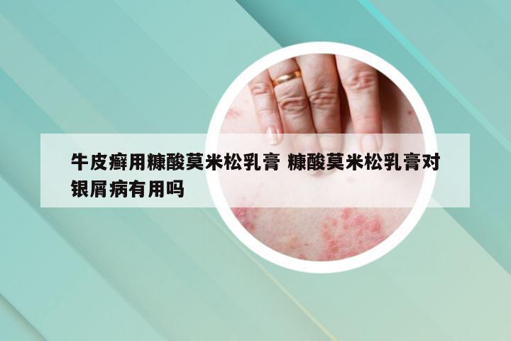 牛皮癣用糠酸莫米松乳膏 糠酸莫米松乳膏对银屑病有用吗