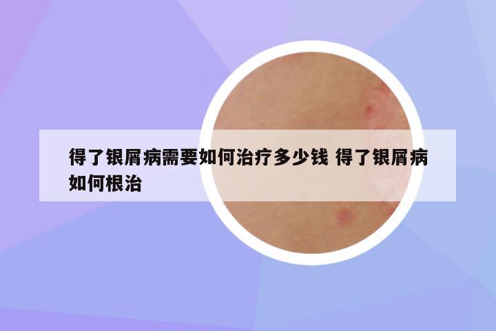得了银屑病需要如何治疗多少钱 得了银屑病如何根治