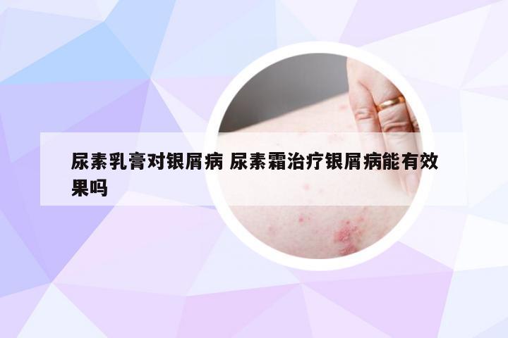 尿素乳膏对银屑病 尿素霜治疗银屑病能有效果吗