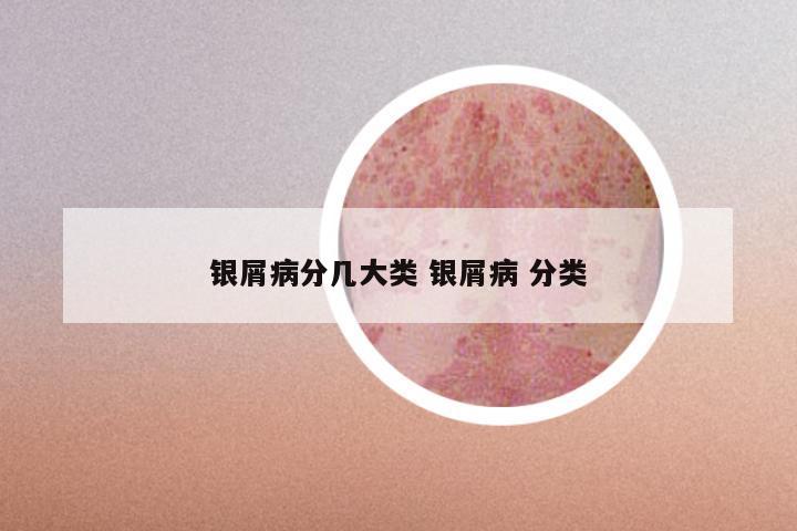 银屑病分几大类 银屑病 分类