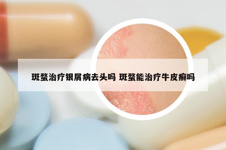 斑蝥治疗银屑病去头吗 斑蝥能治疗牛皮癣吗