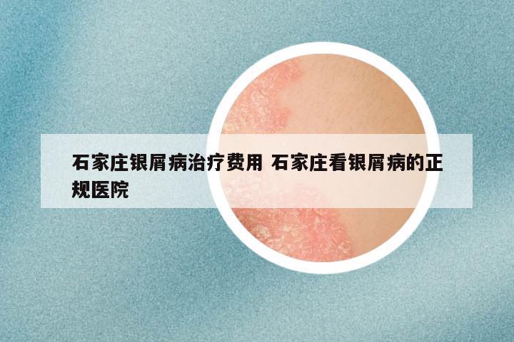 石家庄银屑病治疗费用 石家庄看银屑病的正规医院