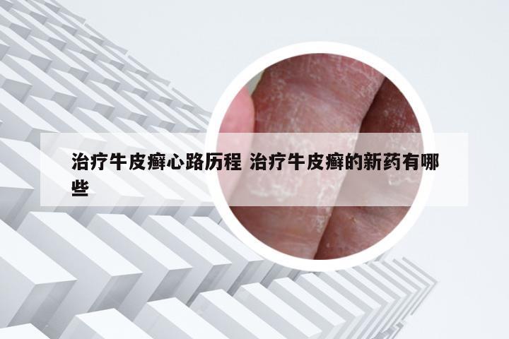 治疗牛皮癣心路历程 治疗牛皮癣的新药有哪些