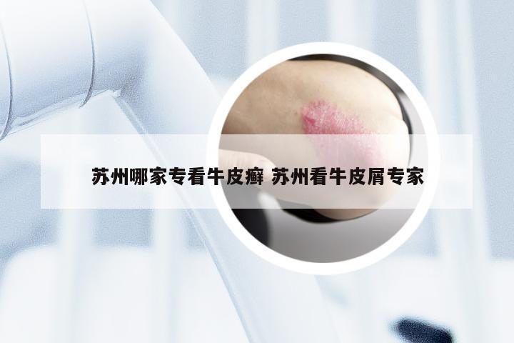 苏州哪家专看牛皮癣 苏州看牛皮屑专家