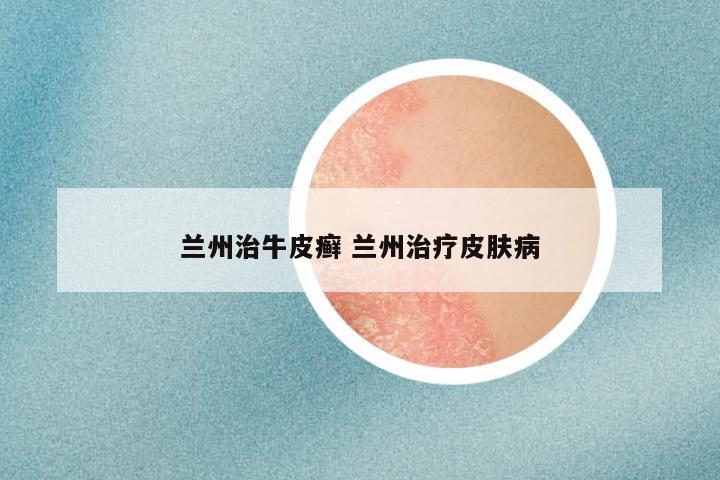 兰州治牛皮癣 兰州治疗皮肤病