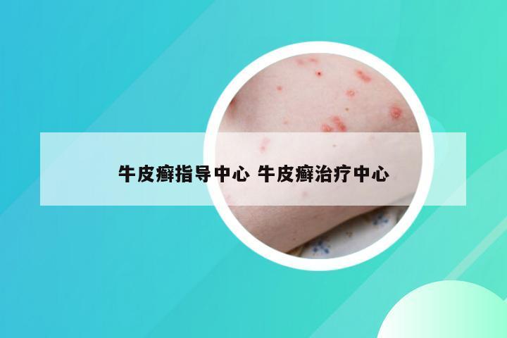 牛皮癣指导中心 牛皮癣治疗中心