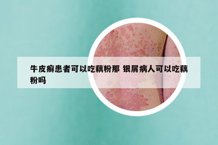 牛皮癣患者可以吃藕粉那 银屑病人可以吃藕粉吗