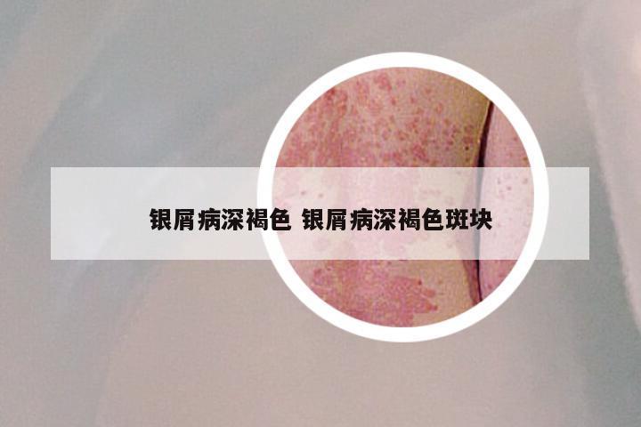 银屑病深褐色 银屑病深褐色斑块
