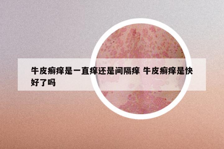 牛皮癣痒是一直痒还是间隔痒 牛皮癣痒是快好了吗