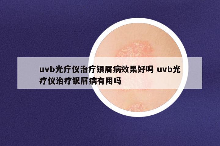 uvb光疗仪治疗银屑病效果好吗 uvb光疗仪治疗银屑病有用吗