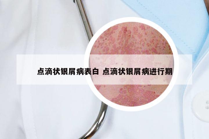 点滴状银屑病表白 点滴状银屑病进行期