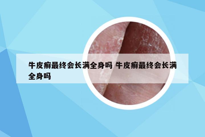 牛皮癣最终会长满全身吗 牛皮癣最终会长满全身吗