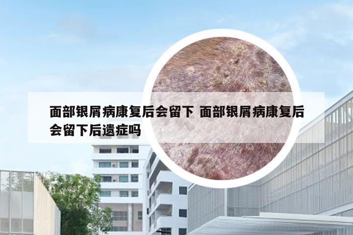 面部银屑病康复后会留下 面部银屑病康复后会留下后遗症吗