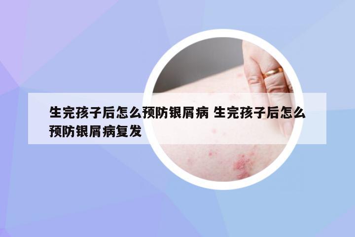 生完孩子后怎么预防银屑病 生完孩子后怎么预防银屑病复发