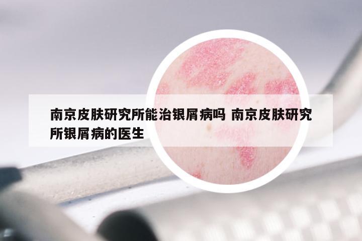 南京皮肤研究所能治银屑病吗 南京皮肤研究所银屑病的医生