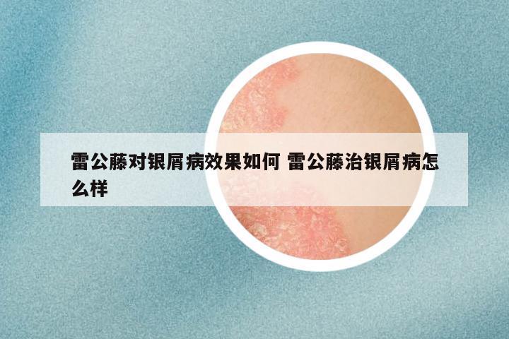 雷公藤对银屑病效果如何 雷公藤治银屑病怎么样
