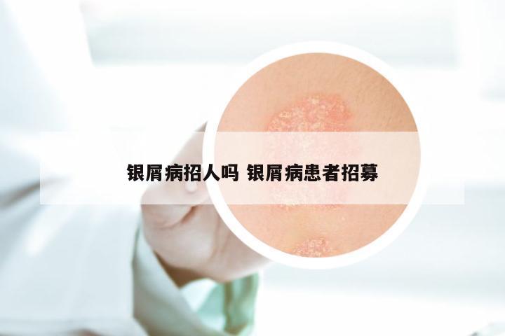 银屑病招人吗 银屑病患者招募