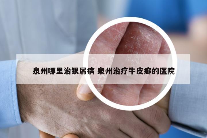 泉州哪里治银屑病 泉州治疗牛皮癣的医院