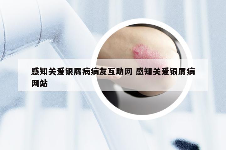 感知关爱银屑病病友互助网 感知关爱银屑病网站