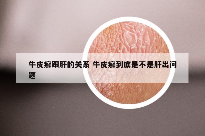 牛皮癣跟肝的关系 牛皮癣到底是不是肝出问题