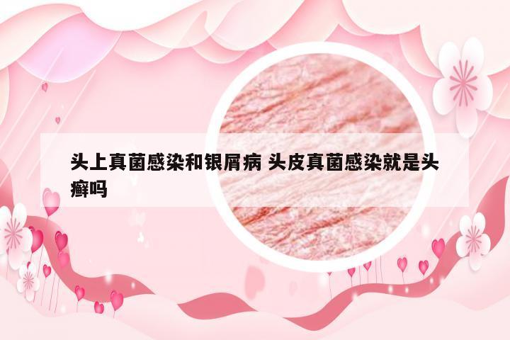头上真菌感染和银屑病 头皮真菌感染就是头癣吗