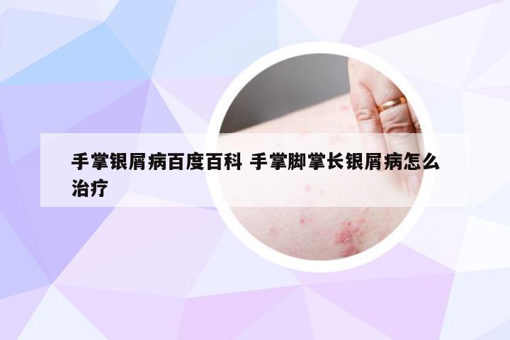 手掌银屑病百度百科 手掌脚掌长银屑病怎么治疗