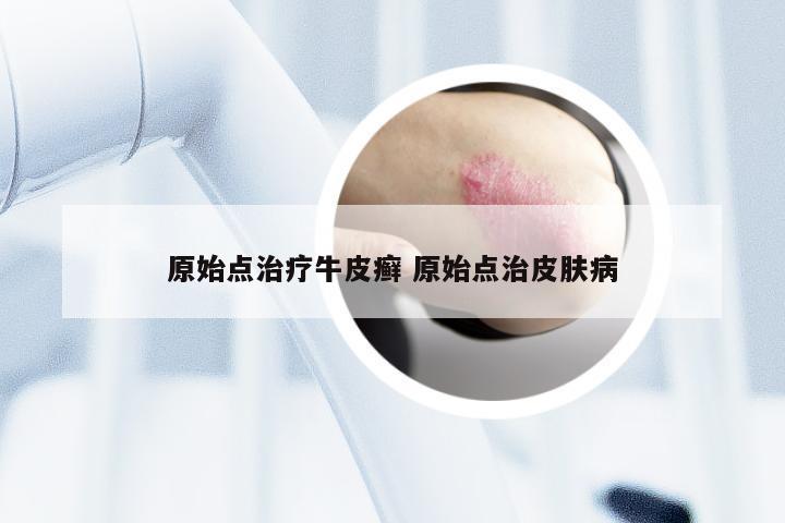 原始点治疗牛皮癣 原始点治皮肤病