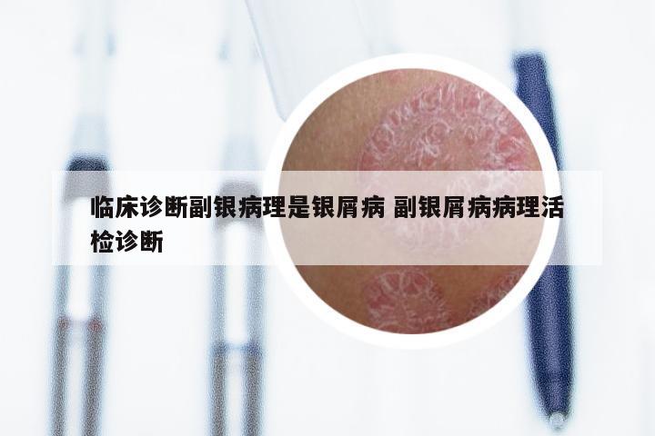 临床诊断副银病理是银屑病 副银屑病病理活检诊断