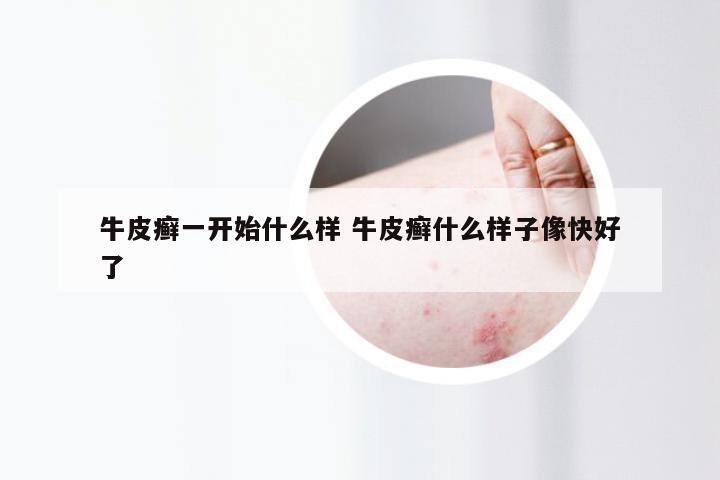 牛皮癣一开始什么样 牛皮癣什么样子像快好了
