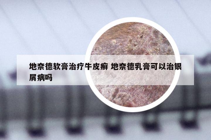 地奈德软膏治疗牛皮癣 地奈德乳膏可以治银屑病吗