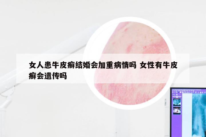 女人患牛皮癣结婚会加重病情吗 女性有牛皮癣会遗传吗