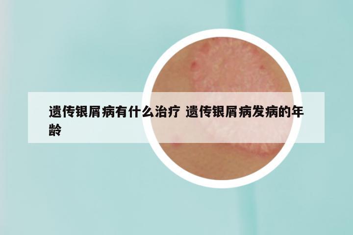 遗传银屑病有什么治疗 遗传银屑病发病的年龄