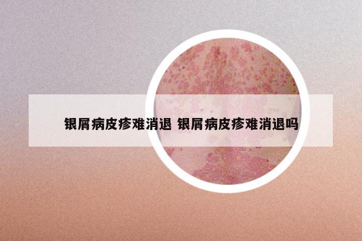 银屑病皮疹难消退 银屑病皮疹难消退吗