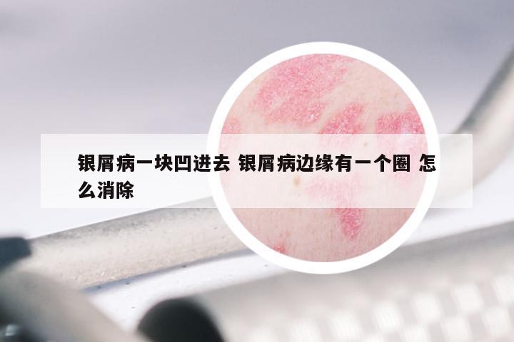 银屑病一块凹进去 银屑病边缘有一个圈 怎么消除