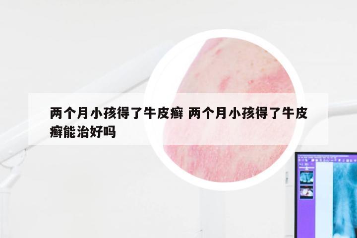 两个月小孩得了牛皮癣 两个月小孩得了牛皮癣能治好吗