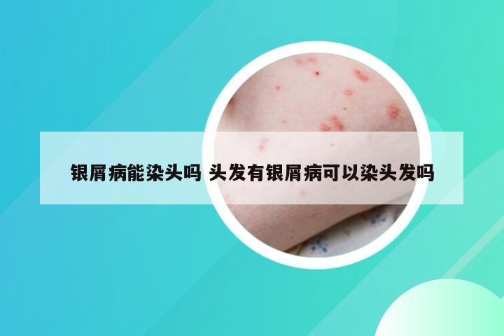 银屑病能染头吗 头发有银屑病可以染头发吗