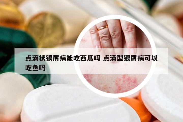 点滴状银屑病能吃西瓜吗 点滴型银屑病可以吃鱼吗