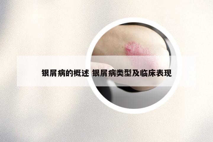 银屑病的概述 银屑病类型及临床表现
